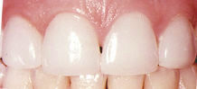 photo of healthy gums