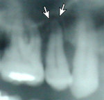 x-ray of abscessed tooth