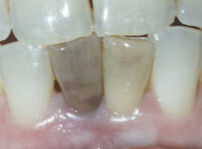 discolored tooth