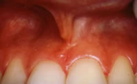 after frenectomy
