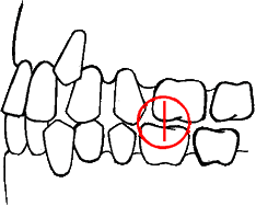 Dental malocclusion caused by crowding