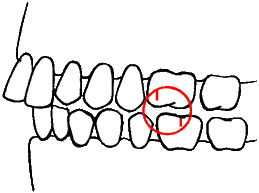 Overbite: Upper jaw protrudes or lower jaw recedes (or both).