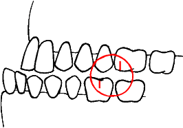 Underbite: Lower jaw protrudes.